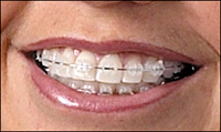 Ceramic Braces