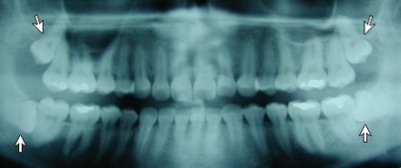 Impacted Third Molars