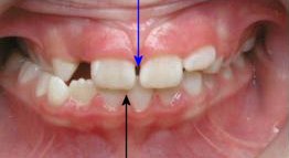 Posterior Crossbite