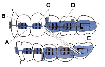 Braces Diagram