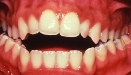 Open Bite (orthodontic example)