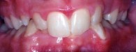 Closed Bite/Deep Bite (orthodontic example)