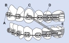 Diagram of Braces (orthodontic example)