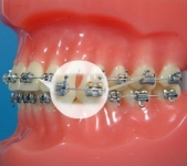 Wires (orthodontic example)