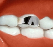 Band (orthodontic example)