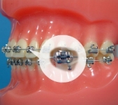 Ligating Modules (orthodontic example)