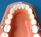 Lip Bumper (orthodontic example)
