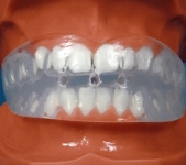Mouthguard (orthodontic example)
