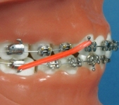 Elastics (orthodontic example)
