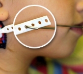 Safety Strap (orthodontic example)
