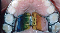 Palatal Expander
