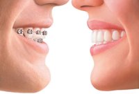 Smile with braces beside a straight smile after clear aligner treatment